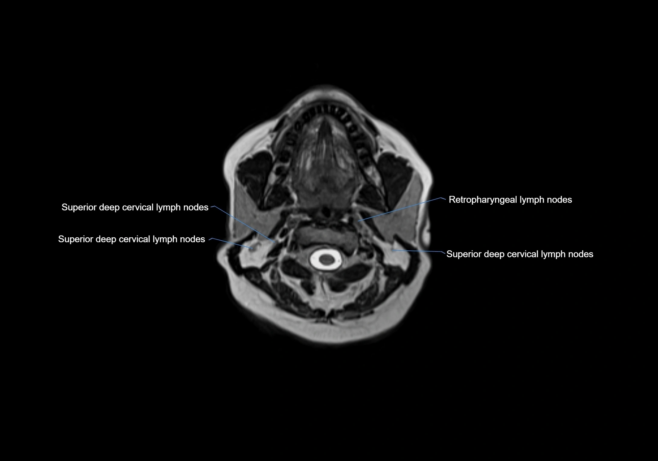Neck axial  lymph node cross sectional MRI anatomy 3T MRI  image-img-00001-00039.webp